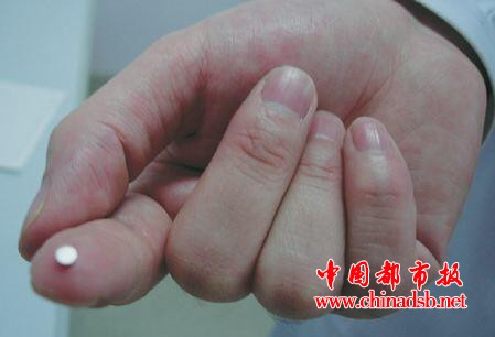 微型窃听器